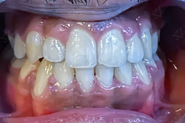 After orthodontic teeth straightening result Abu Dhabi