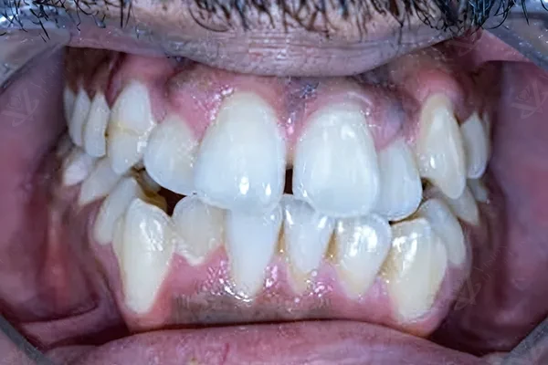 Before orthodontic braces treatment Abu Dhabi
