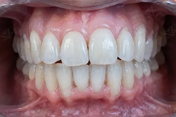 After Invisalign teeth straightening Abu Dhabi