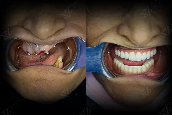 Dental implants Abu Dhabi — Straumann implant specialist at Vision Dental Clinic