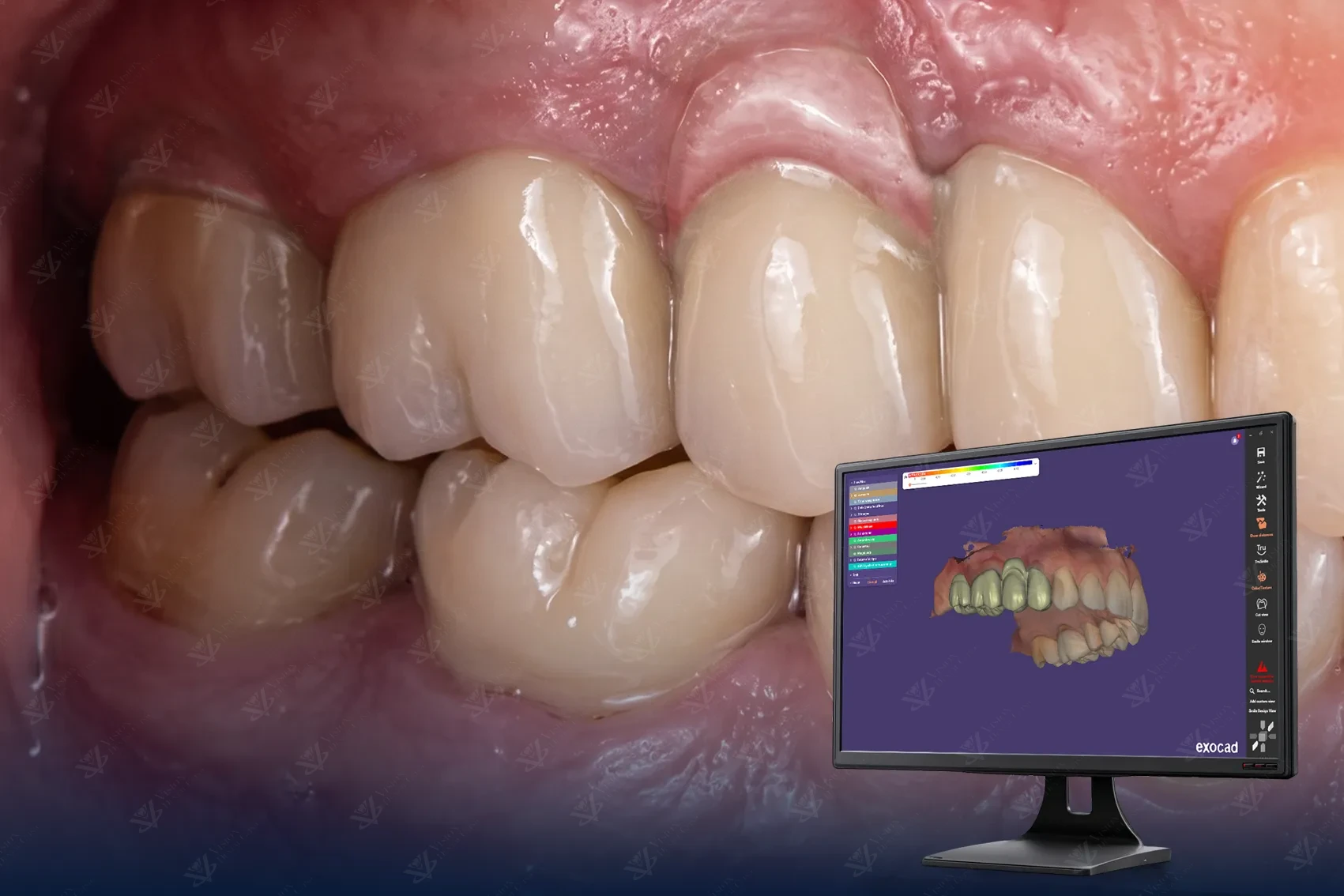 Prosthodontics dental crowns and bridges Abu Dhabi