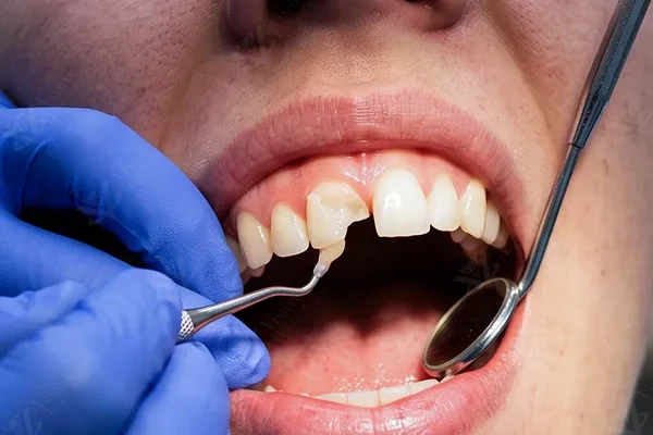 Dental fillings and tooth restoration Abu Dhabi