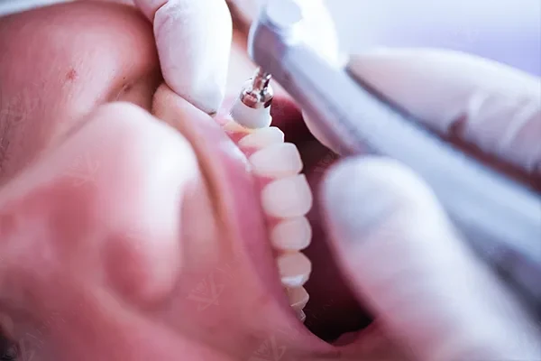 Professional dental scaling and polishing hygiene treatment Abu Dhabi