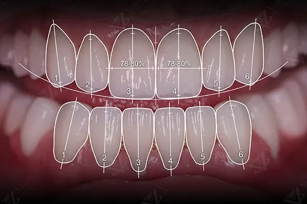 Digital smile design technology for Hollywood Smile Abu Dhabi