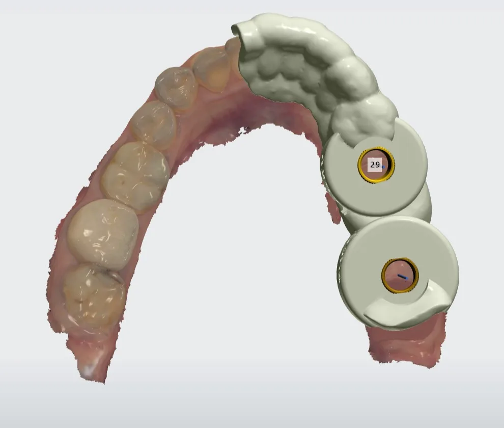 CBCT guided dental implant surgery Abu Dhabi