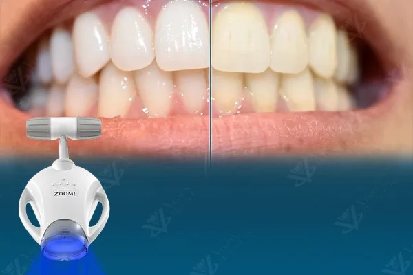 Professional teeth whitening Abu Dhabi